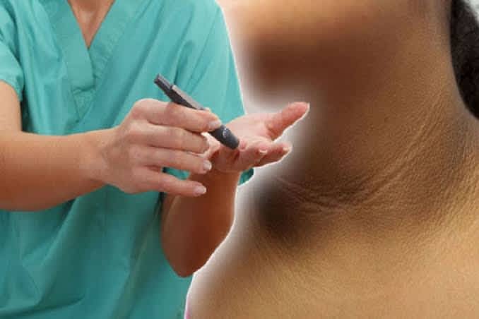 Bahaya diabetes kulit menggelap