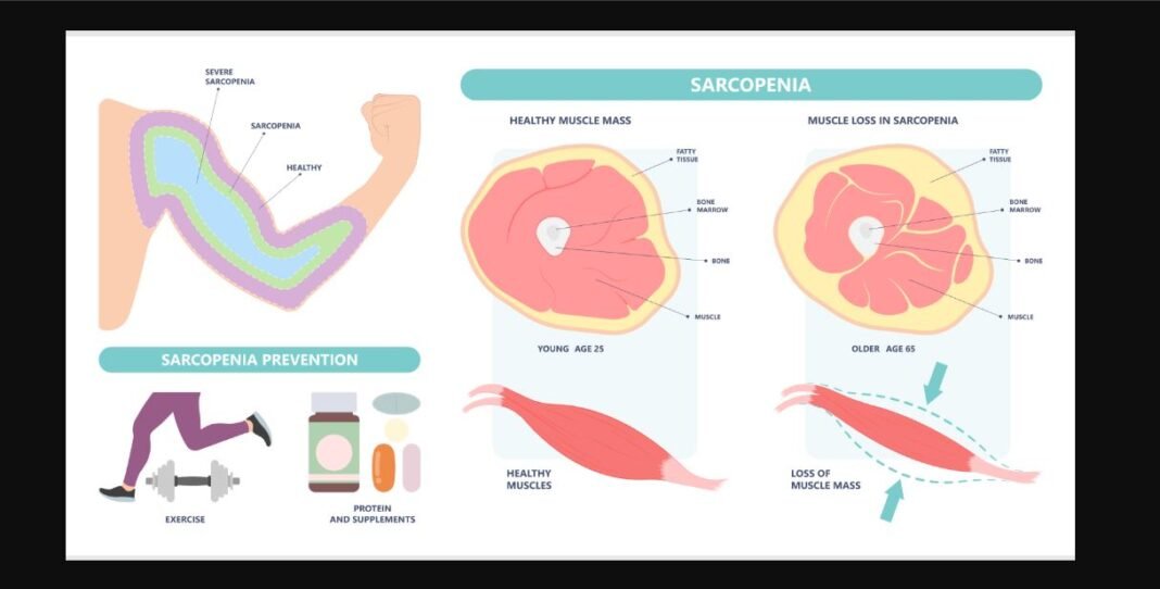 sarcopenia, lansia, kesehatan otot, penuaan, olahraga lansia, nutrisi lansia, pencegahan sarcopenia, kekuatan otot, hidup sehat