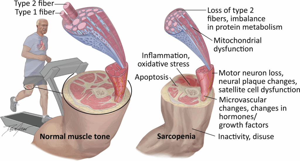 sarcopenia, lansia, kesehatan otot, penuaan, olahraga lansia, nutrisi lansia, pencegahan sarcopenia, kekuatan otot, hidup sehat